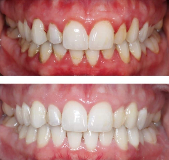 how to improve gum health quickly