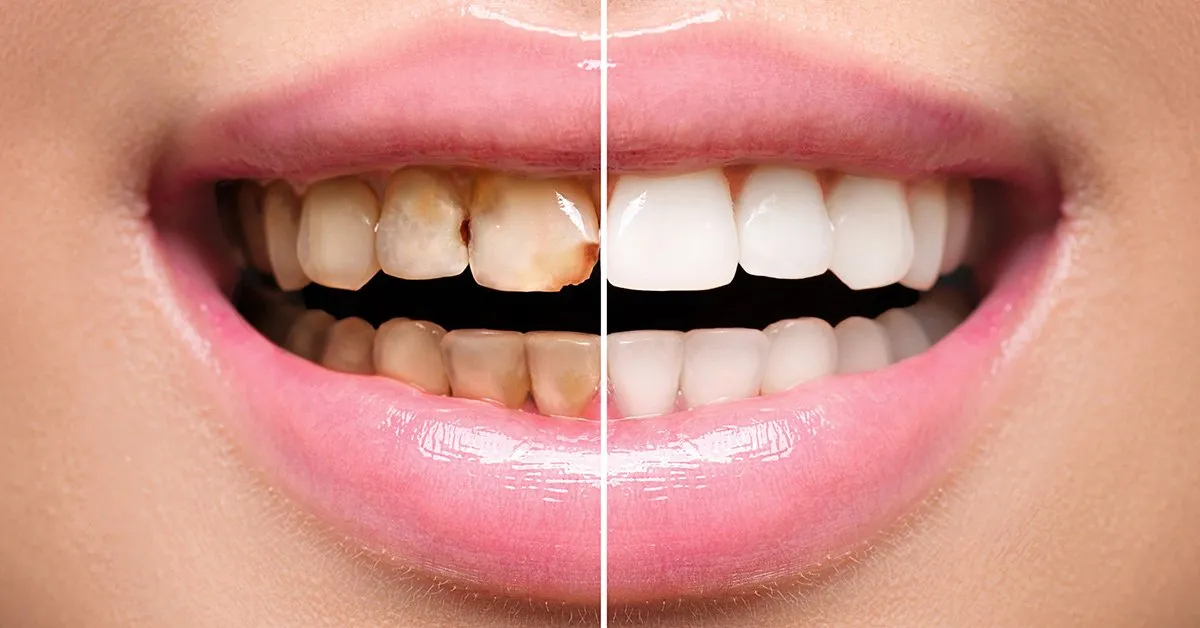 Cheap dental veneers Sharjah