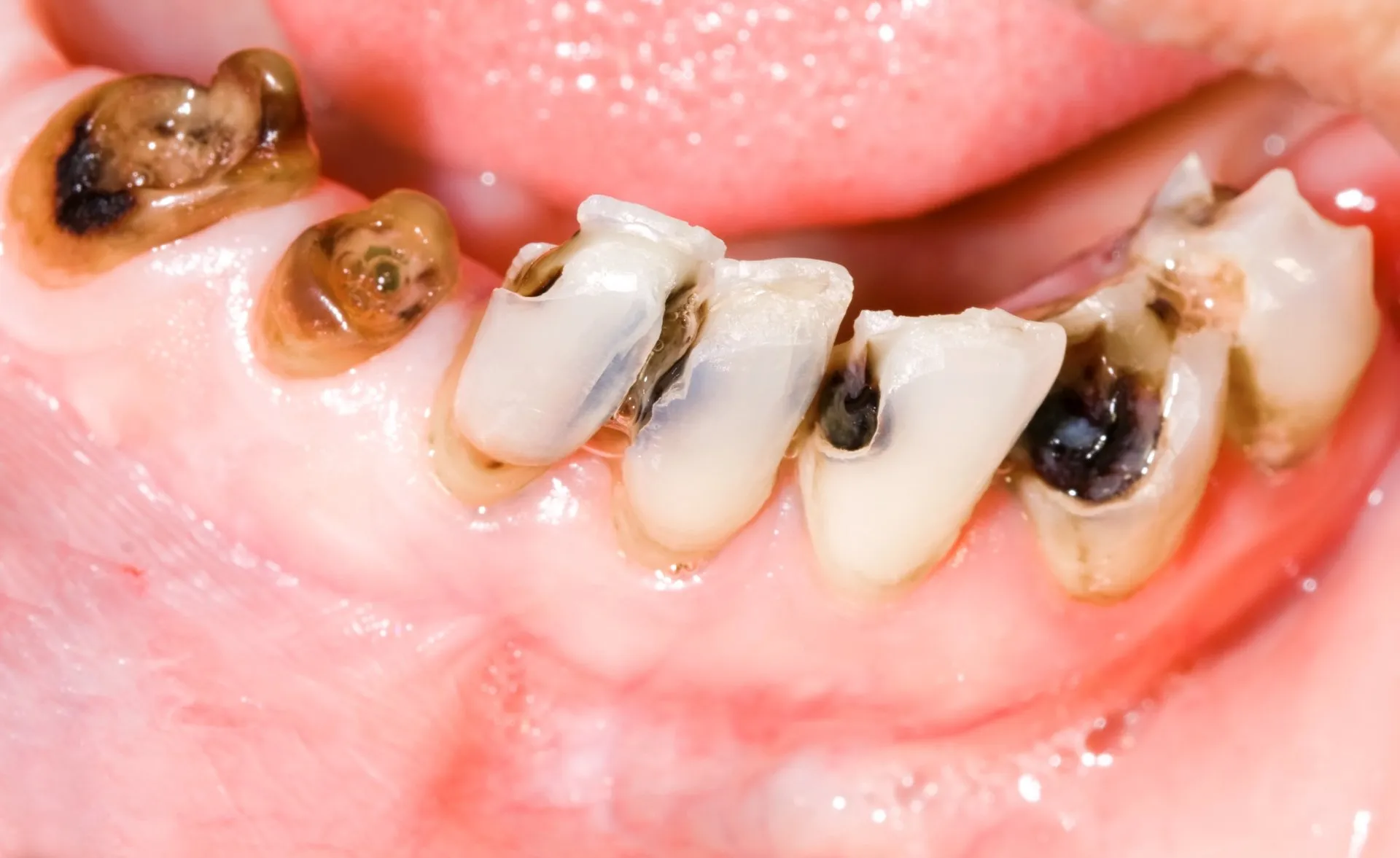 Tooth Decay Causes and Treatments Ajman UAE