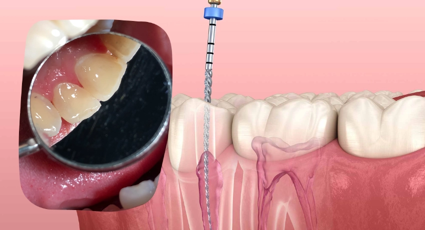 Top Painless Root Canal Treatments in Ajman uae dubai